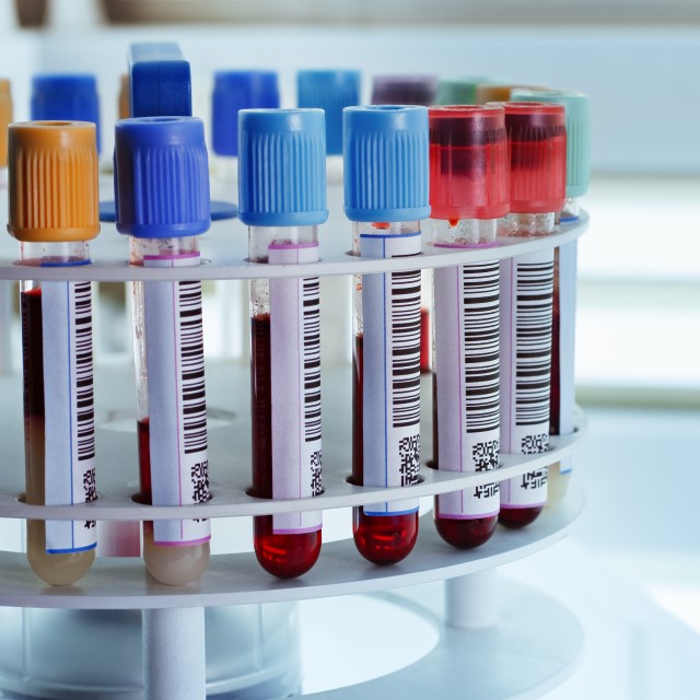 A rack of blood samples in vials